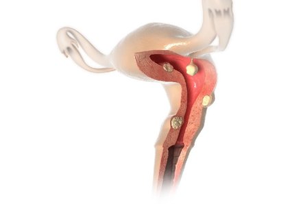 uterus-befund-myom-polyp-160916_LQ