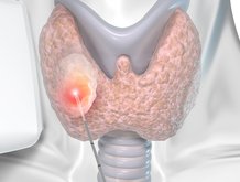 ThyLa_laser_fiber_by_biolitec_R__during_treatment