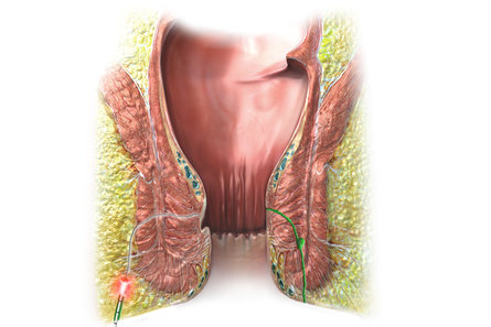 FiLaC_Laserfaser_der_biolitec_waehrend_der_Behandlung_einer_Analfistel___c__biolitec_R__